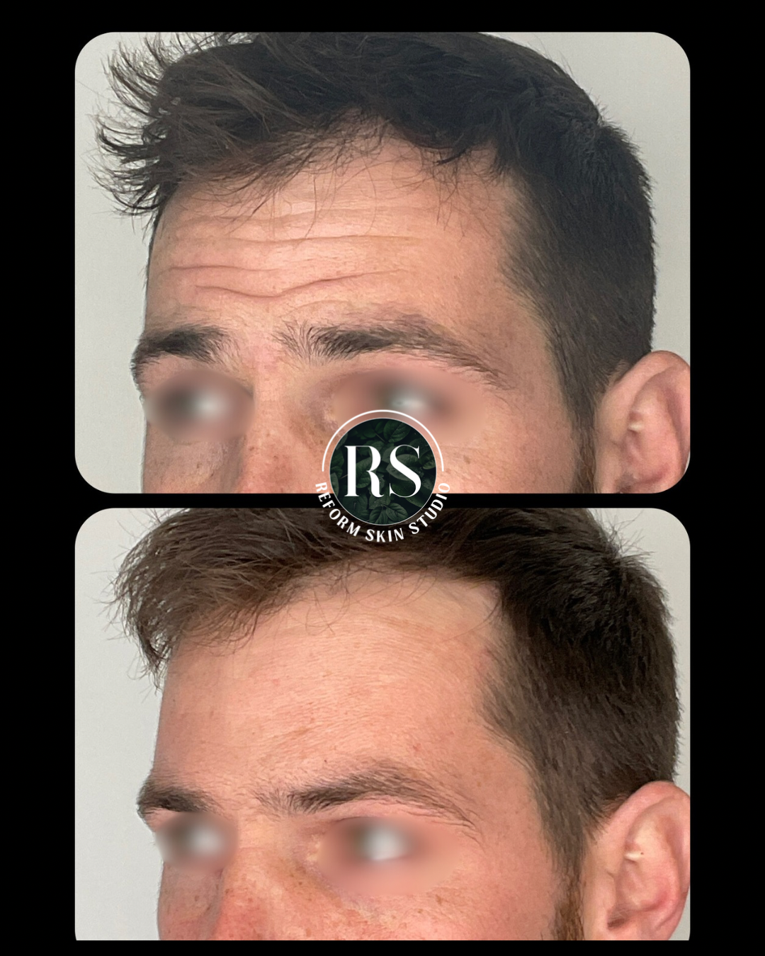 Before and after treatment result published by Reform Skin Studio with the client's eyes obscured